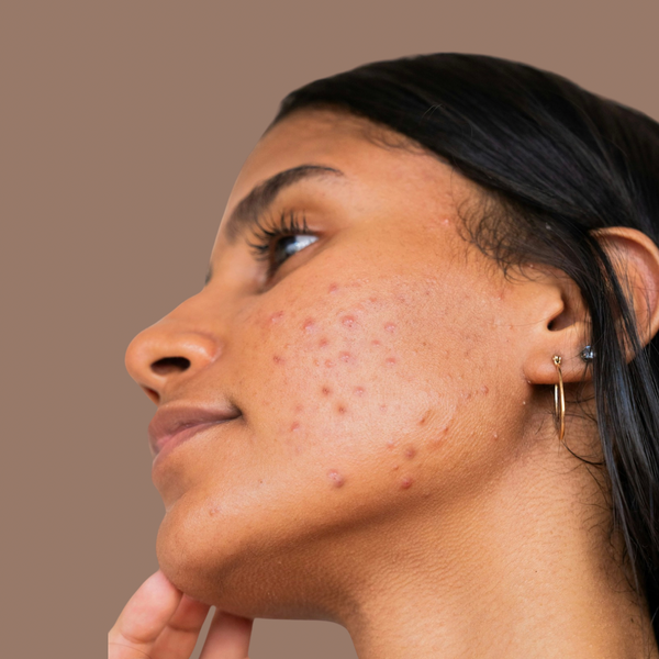 Hormonal acne