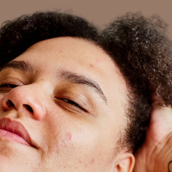 Adult Acne That Won't Settle
