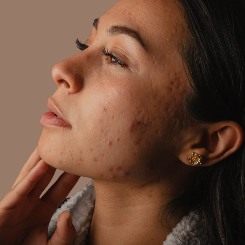 Hormonal Acne