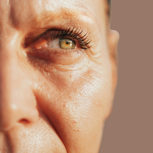 Adult acne
